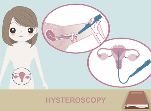 best doctors for uterus removal or Hysteroscopy in delhi