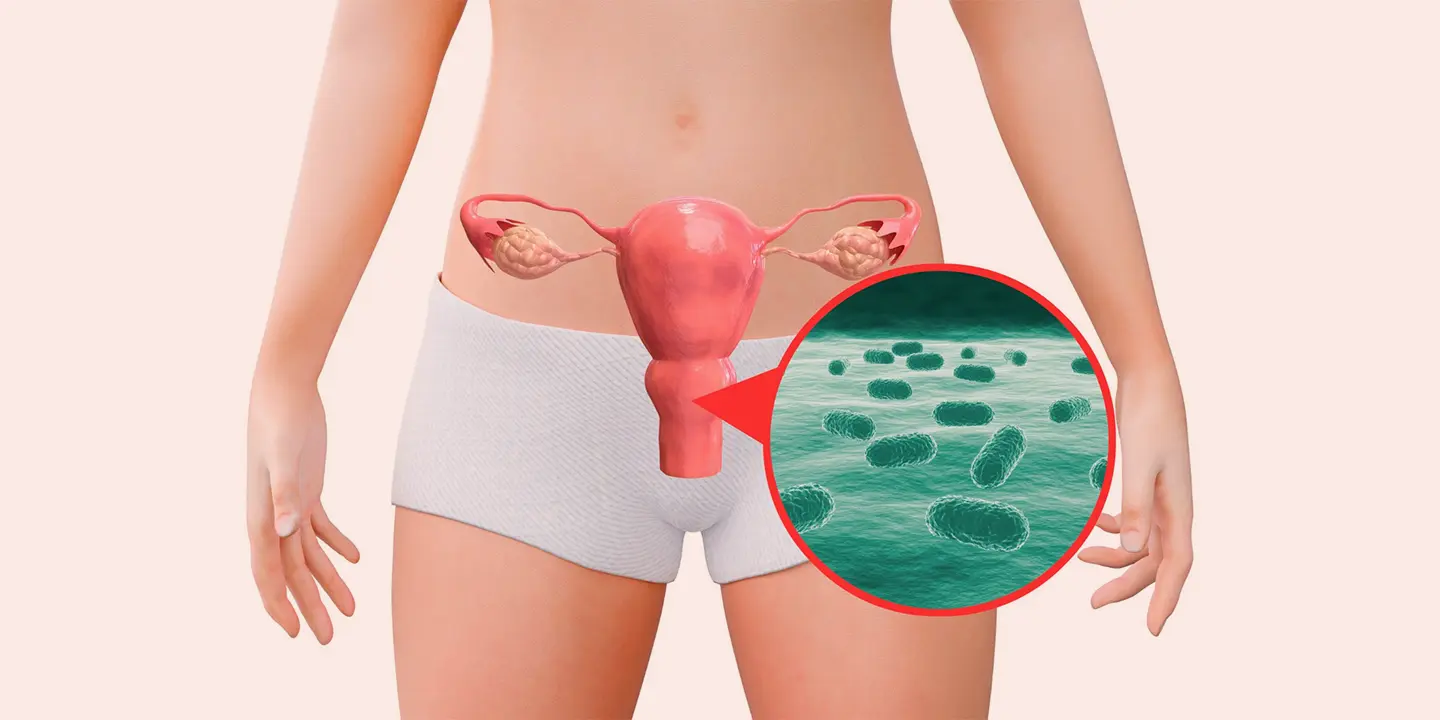 Bacterial Vaginosis (BV): Causes, Symptoms & Treatment - Queens Health